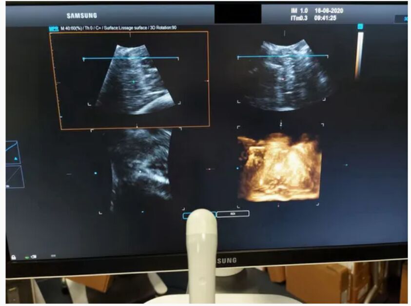 Samsung Medison V5-9 3D/4D Volume Convex Ultrasound Transducer