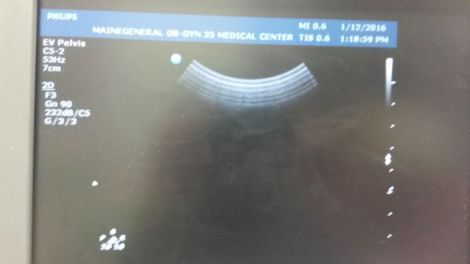Philips C5-2 Curved Array Ultrasound Transducer