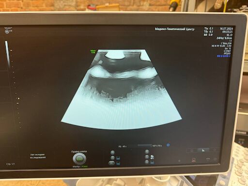 GE Healthcare Voluson E10 BT21 Ultrasound System